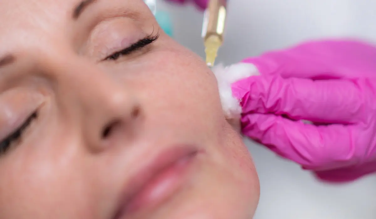 injection de sculptra dans la joue