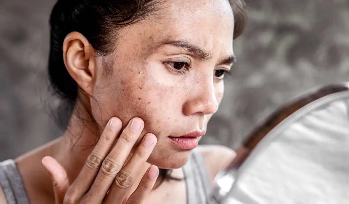 Jeune femme avec des nombreuses tâches brunes