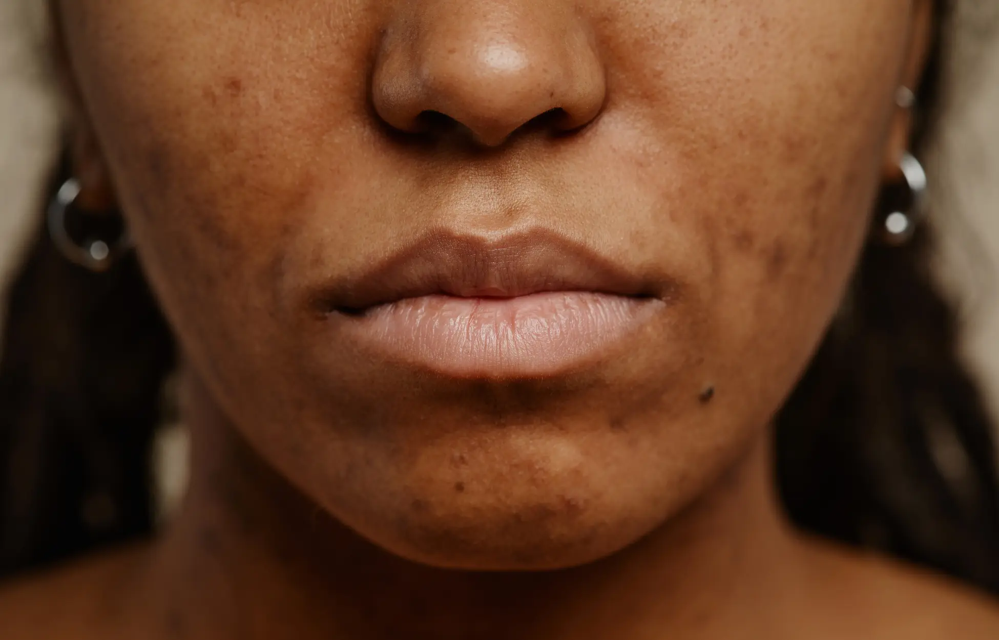 Jeune femme noire dont le visage connait des tâches brunes