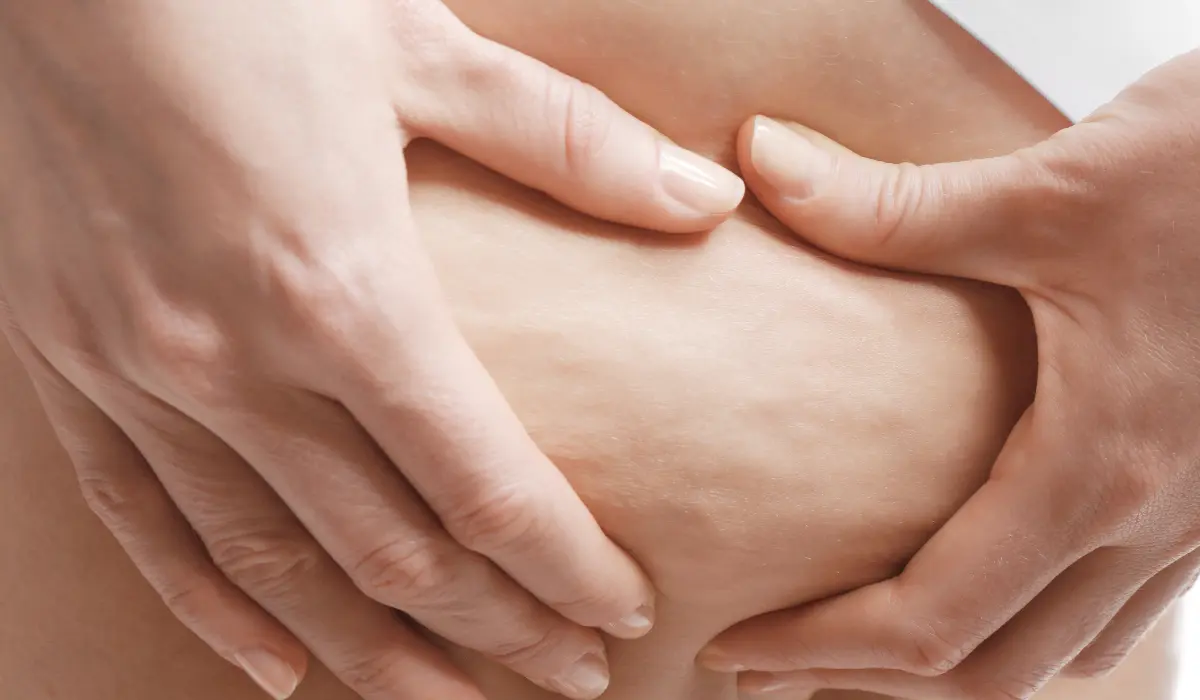 Cellulite en gros plan
