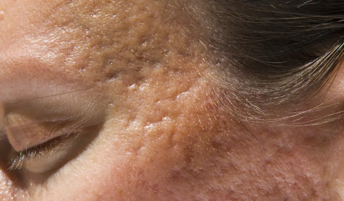 Cicatrice d'acné femme 50 ans