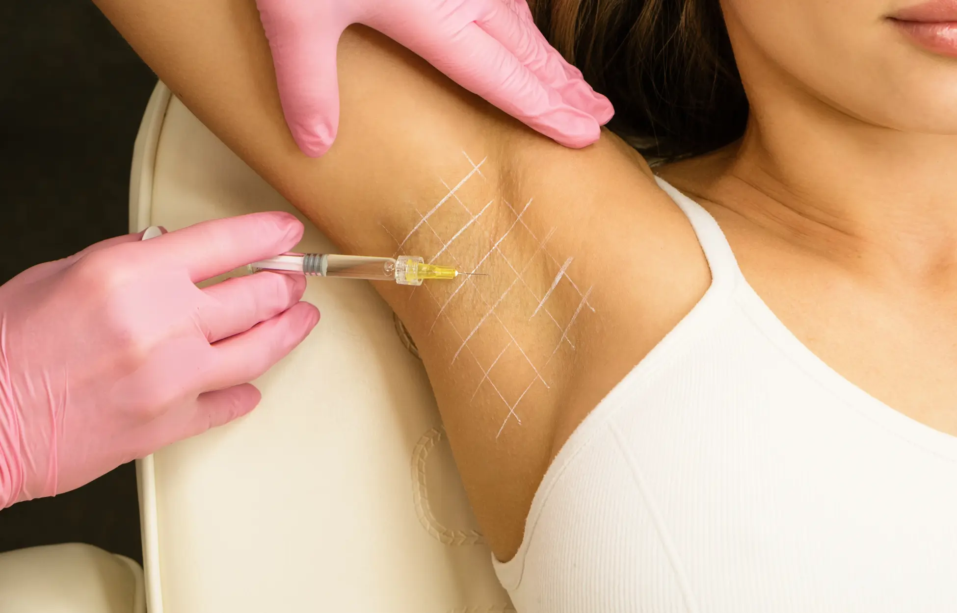 Hyperhidrose traité par le botox sur une femme
