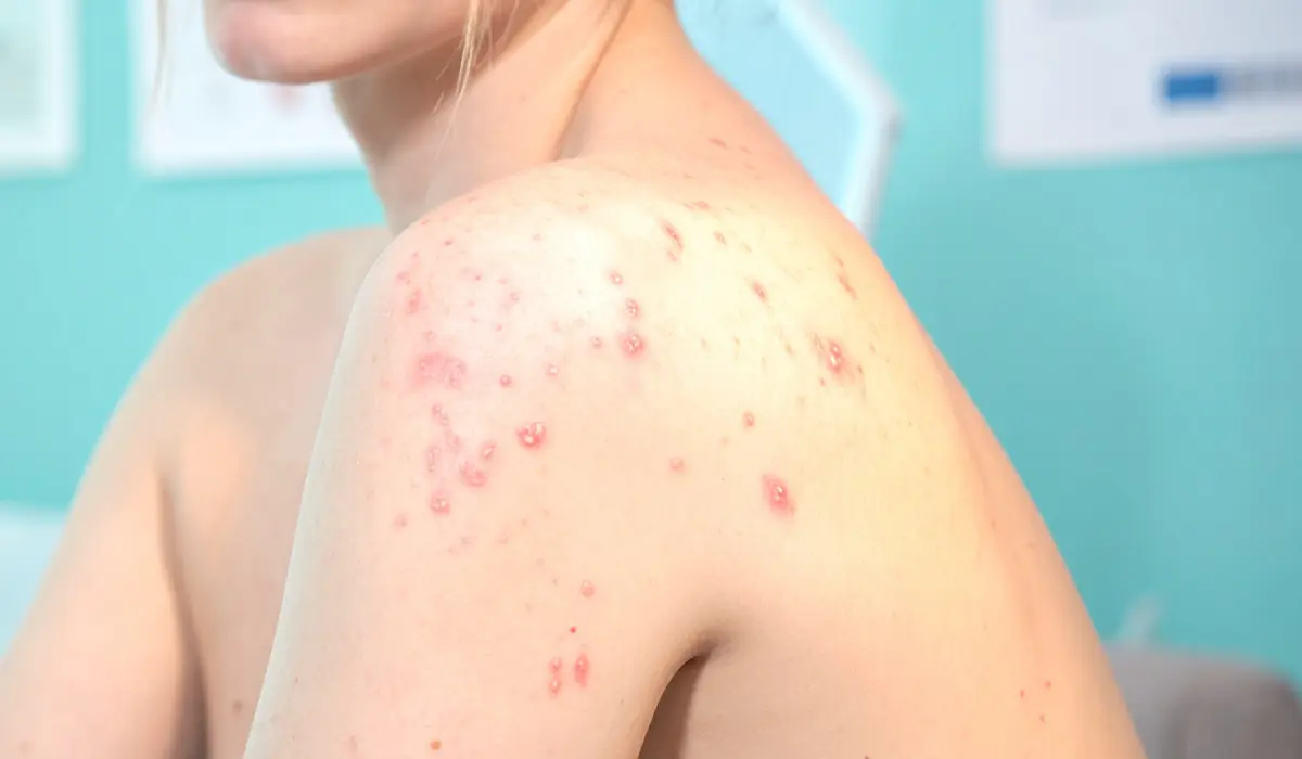 cicatrices d'acné abondantes sur le corps d'une jeune femme