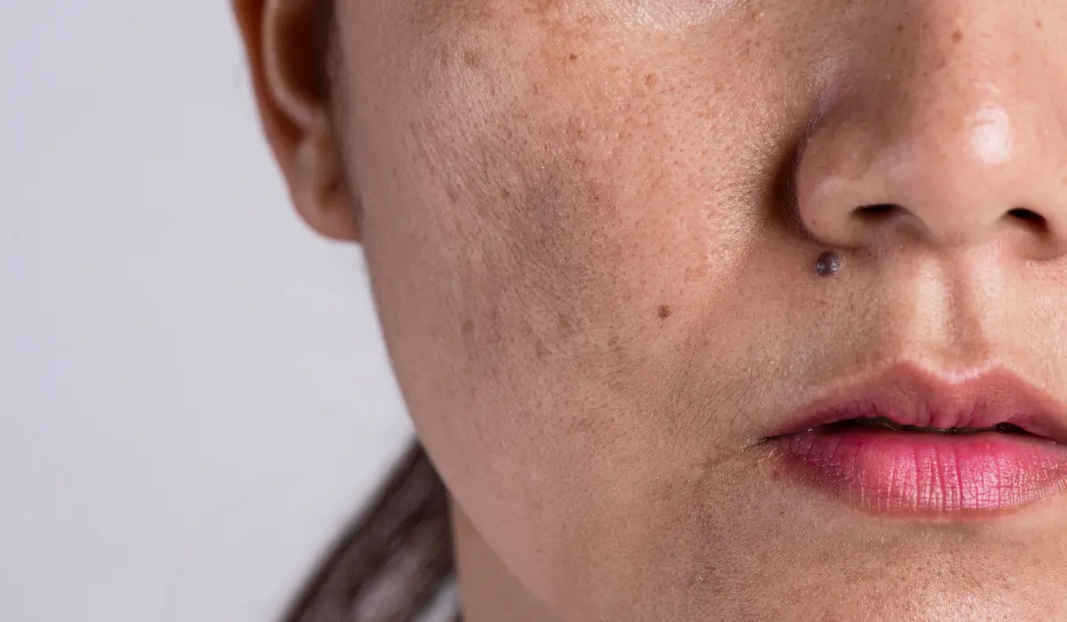 melasma sur le visage d'une femme