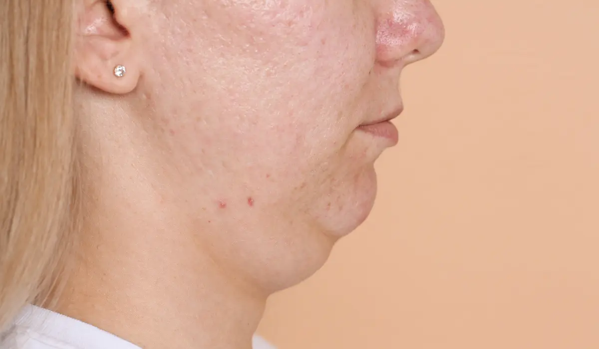 double menton sur femme blonde