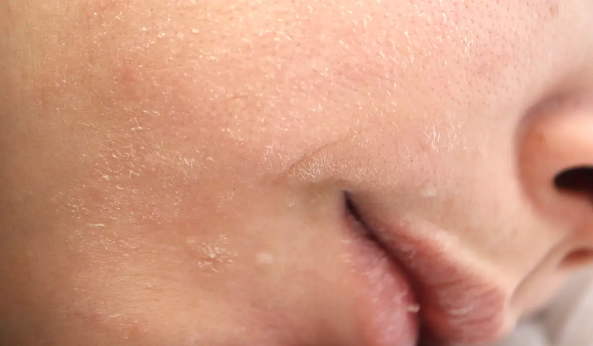 peau fatiguée par l'hiver