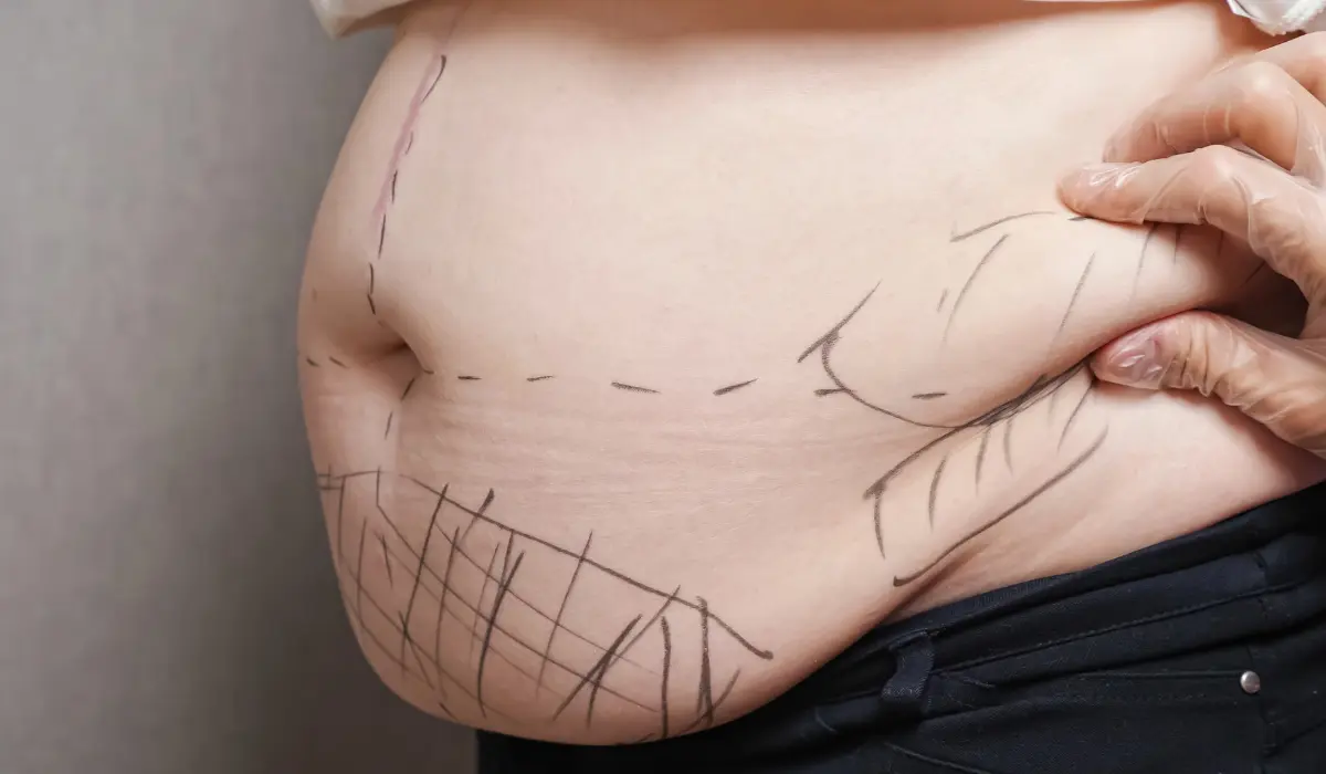 ventre d'une femme marqué au feutre par un chirurgien esthétique
