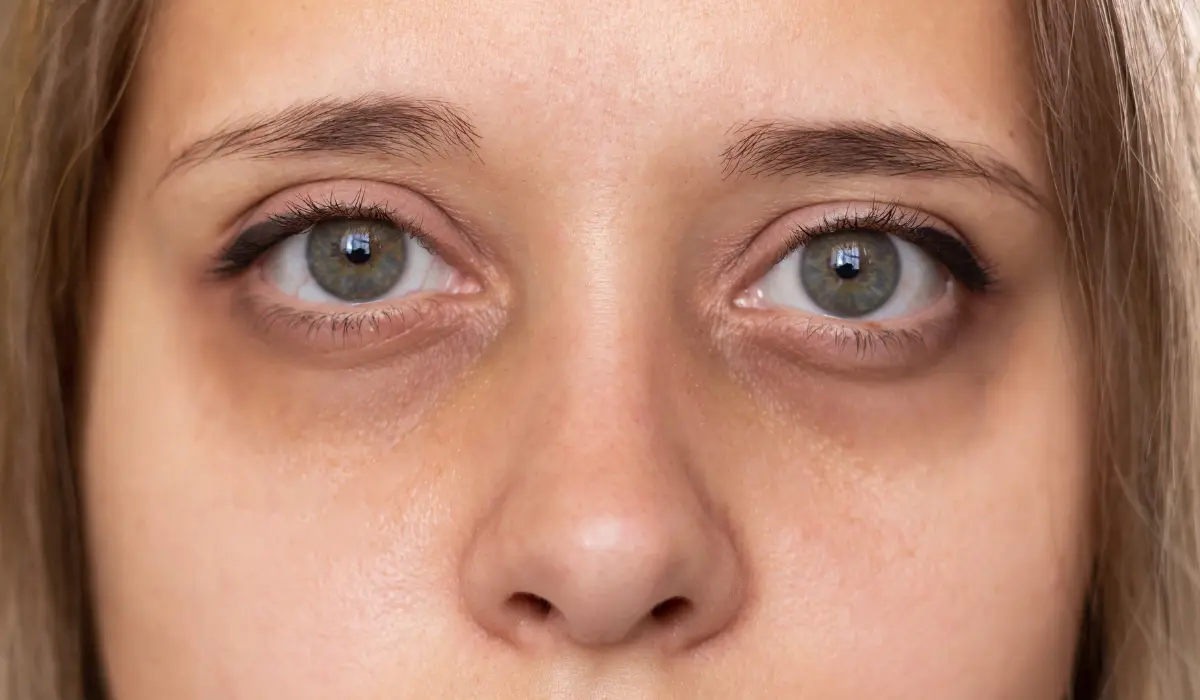 Jeune femme avec d'importantes cernes sous les yeux