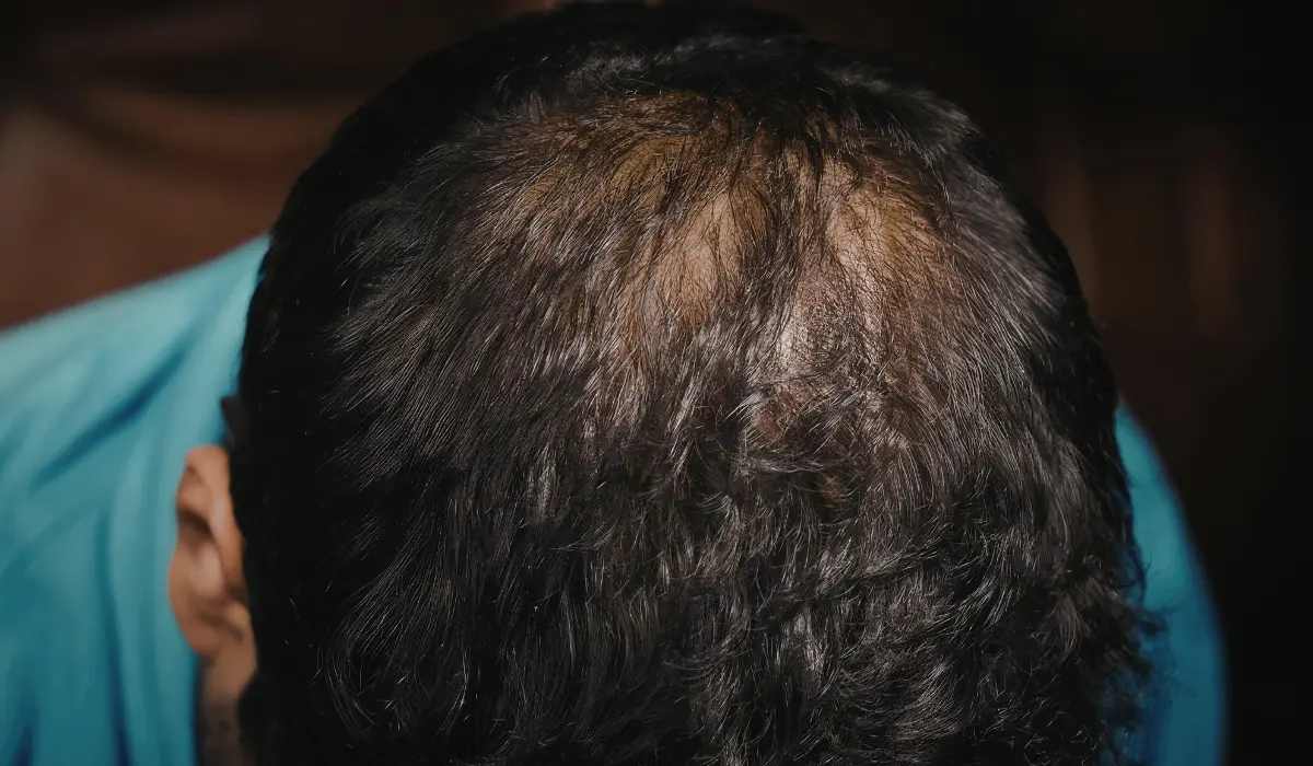 Tête ayant besoin d'une greffe de cheveux