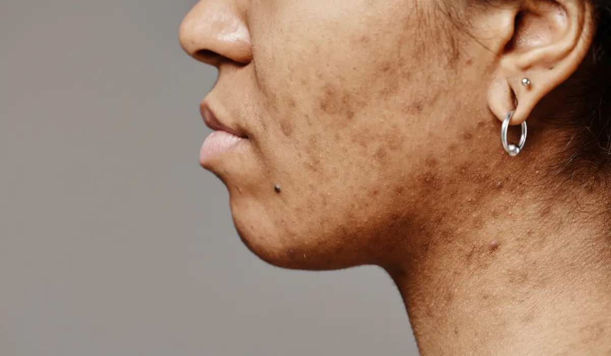 tâches brunes sur le visage